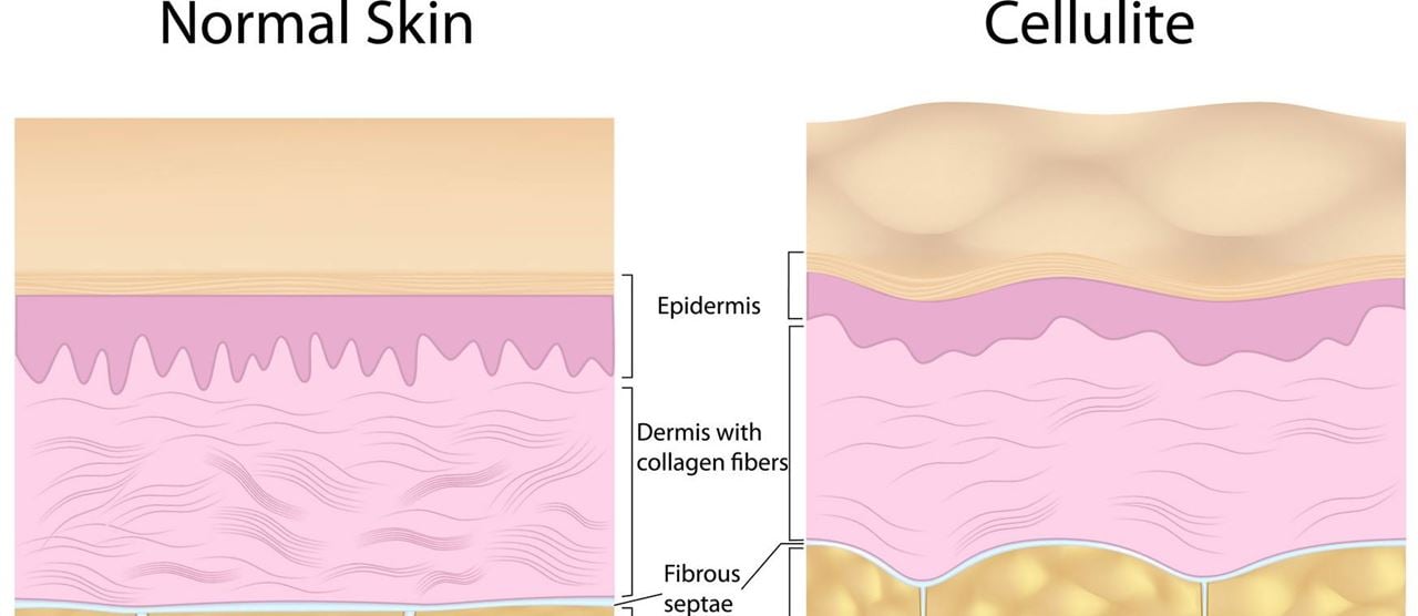5 Facts about Cellulite